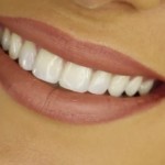 teeth-whitening-3P